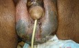 Fornier's Gangrene