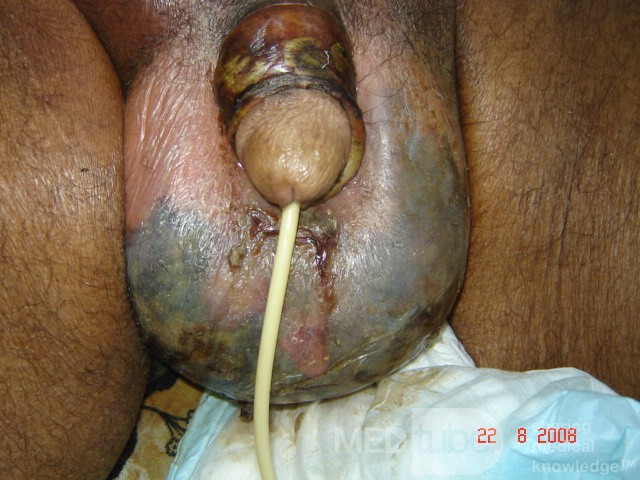 Fornier's Gangrene