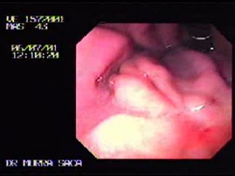 Early Gastric Carcinoma With Signet Ring Cells - Endoscopy (2 of 3)