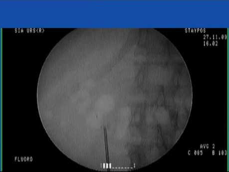 Kidney Stone - Removed With A Basket