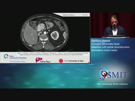Complex Pancreatic Head Resection with Portal Reconstruction Planned in Mixed Reality - SMIT 2019