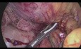 Laparoscopic Complete Mesocolic Excision (CME) and D3 Lymphadenectomy for Hepatic Flexure Tumor