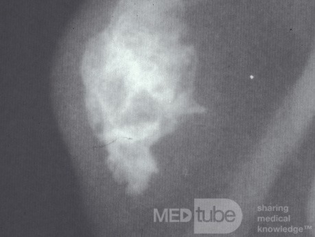 Frostbite Induced Ossification of the Auricular Cartilage