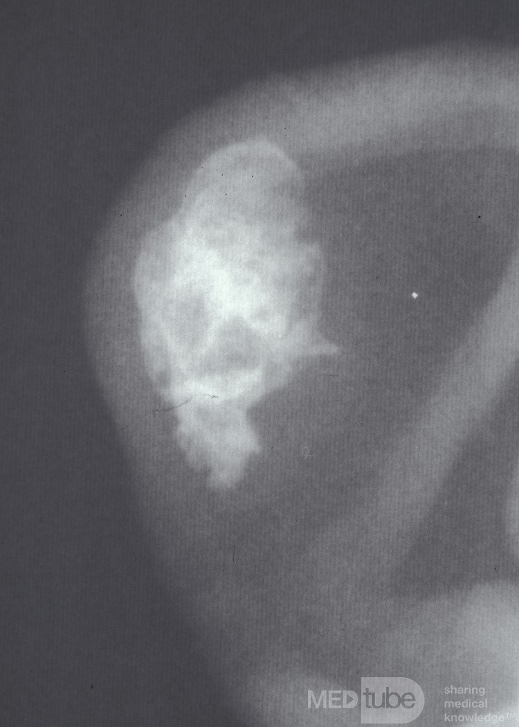 Frostbite Induced Ossification of the Auricular Cartilage