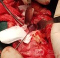 Total Resection of the Lesion Through a Lateral Fronto-Zygomatic Orbit Approach