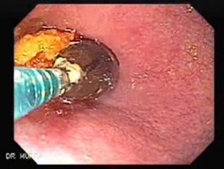 Esophageal Stricture After Total Gastrectomy And Chemoradiation - Baloon Dilation - 6/6