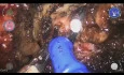 Radical Prostatectomy Post-Radiotherapy with Perineal Prostatic Fistula