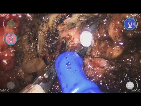Radical Prostatectomy Post-Radiotherapy with Perineal Prostatic Fistula