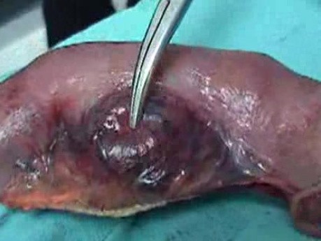 Jejunal Gastrointestinal Stromal tumor (GIST) (4 of 86)