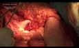 Whipple procedure ( Pancreatogastrostomy )
