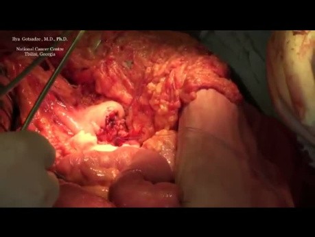 Whipple procedure ( Pancreatogastrostomy )