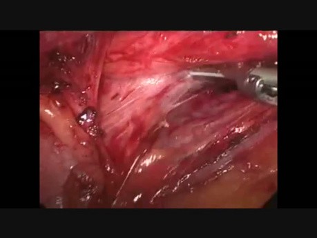 Laparoscopic Nissen Fundoplication