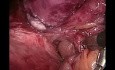 Laparoscopic ventral incisional hernia repair with mesh