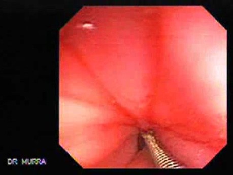 Duodenal Ulcer and Bleeding (6 of 23)
