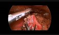 Laparoscopic Repair of Gastric Perforation