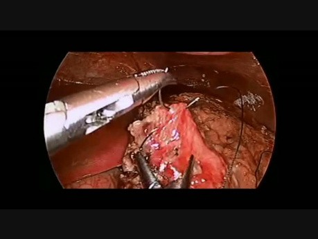 Laparoscopic Repair of Gastric Perforation