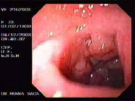 Duodenal B Cell Lymphoma (1 of 7)