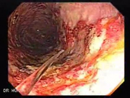 Multiple Rectal Ulcers (15 of 110)