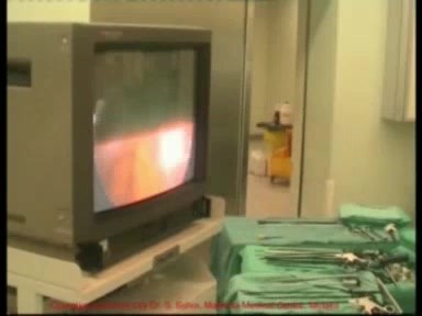 Laparoscopy