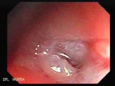 Colon Angiodysplasia (15 of 24)