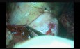 Aortic Cannulation for Cardiopulmonary Bypass:  Arie Blitz, MD