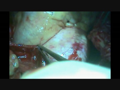 Aortic Cannulation for Cardiopulmonary Bypass:  Arie Blitz, MD