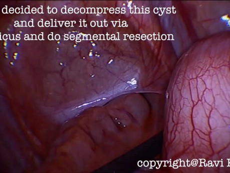 Laparoscopic Excision of Jejunal Duplication Cyst