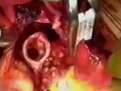 Right Lung Transplant and Simultaneous Heart Transplant 