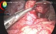 Complicated Appendix Reduced
