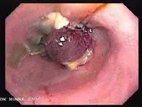 Endoscopic Variceal Ligation - Shallow Ulcers