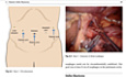 Robotic-Assisted Minimally Invasive Surgery
