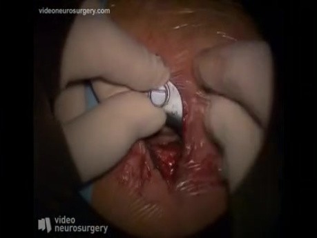 Cervical Arthrodesis - Anterior Approach