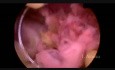 Retained Products of Conception