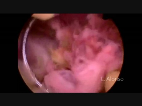 Retained Products of Conception