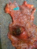 Ascending Colon Intussusception due to a Adenocarcinoma (4 of 6)