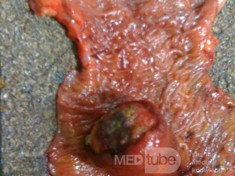 Ascending Colon Intussusception due to a Adenocarcinoma (4 of 6)