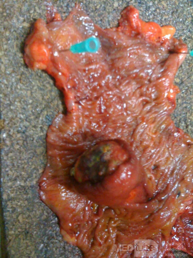 Ascending Colon Intussusception due to a Adenocarcinoma (4 of 6)