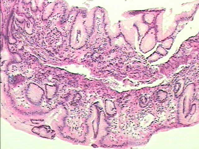 Small cell carcinoma of the lung that invades the upper and
 the middle third of the Esophagus (5 of 7)