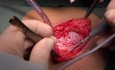 Fascia Lata Harvesting