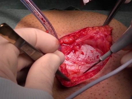 Fascia Lata Harvesting