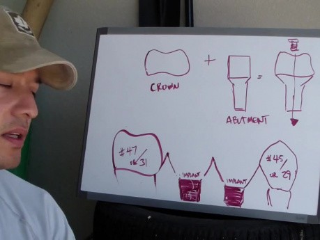 Screw Retained Implant Crowns - White Board Discussion