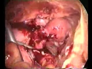 Laparoscopic Treatment Of Acute Pevic Inflamation Disease