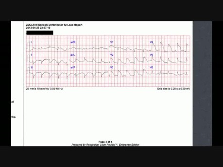ECG Case 2