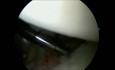 Bankart and Slap Repair Shoulder