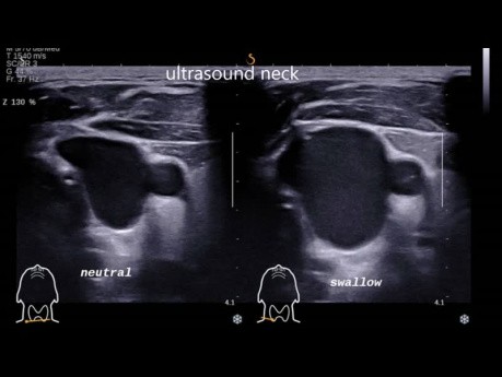 Swelling Caused By Phlebectasia of Right Internal Jugular Vein