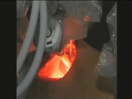 Robotic Thyroidectomy Transaxillary