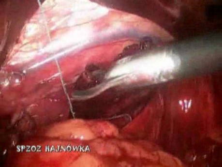 Hiatal Hernia