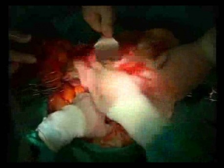 Open Right Hemicolectomy – Technical Principles - Operation No 2 - Part 4