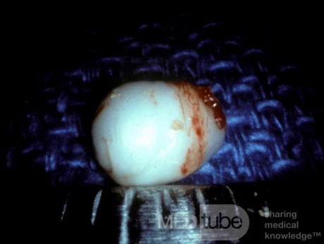Congenital Epidermal Cyst of the Middle Ear Surgical Specimen