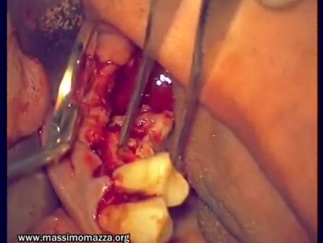 Immediate Implantation 14-18 (1/2)